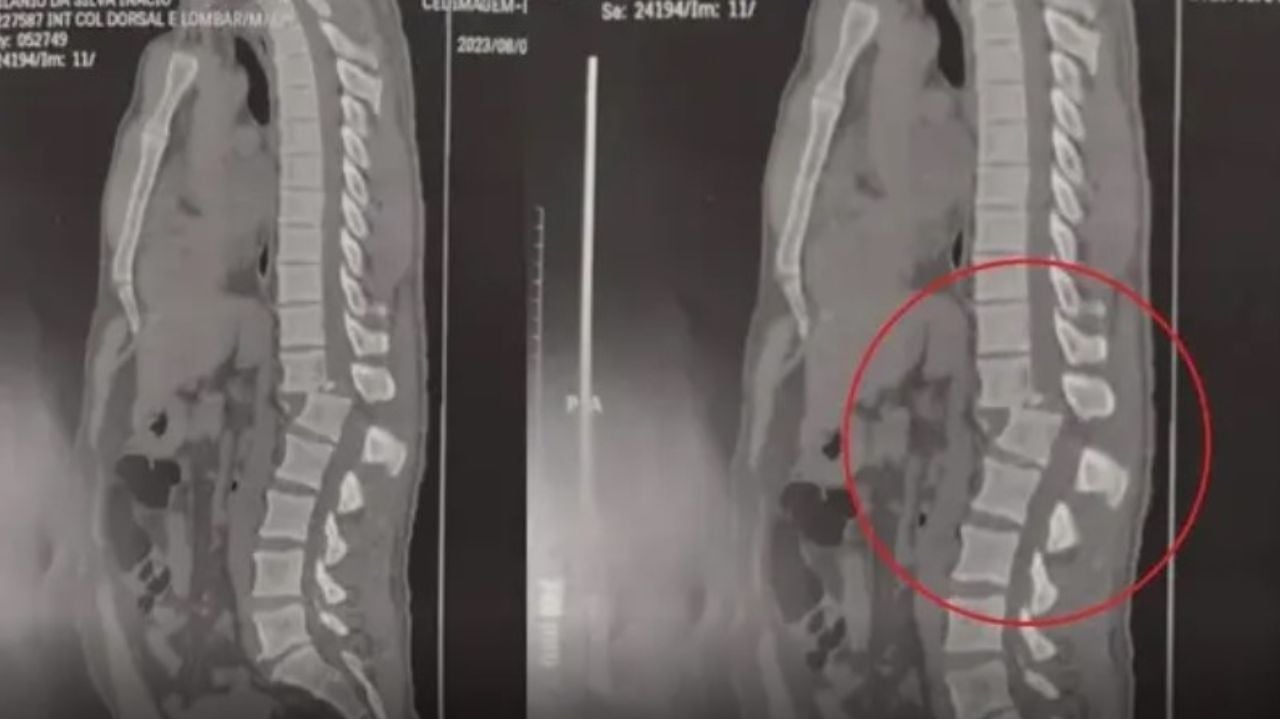 Entenda a lesão e a cirurgia do homem atingido por um aparelho na academia