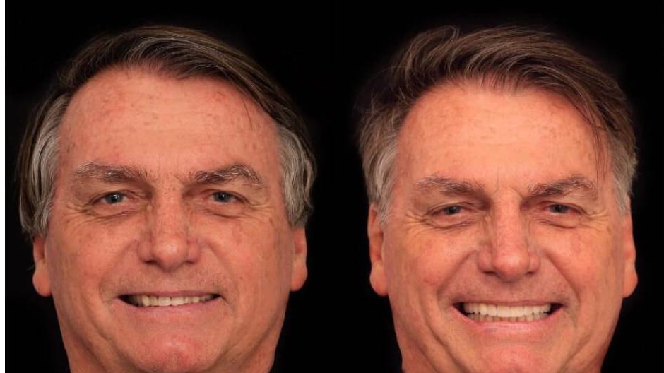Bolsonaro realiza harmonização facial e gasta 3 mil reais em cada dente