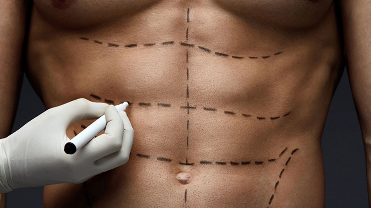 Abdominoplastia em homens: saiba os cuidados no pós-operatório