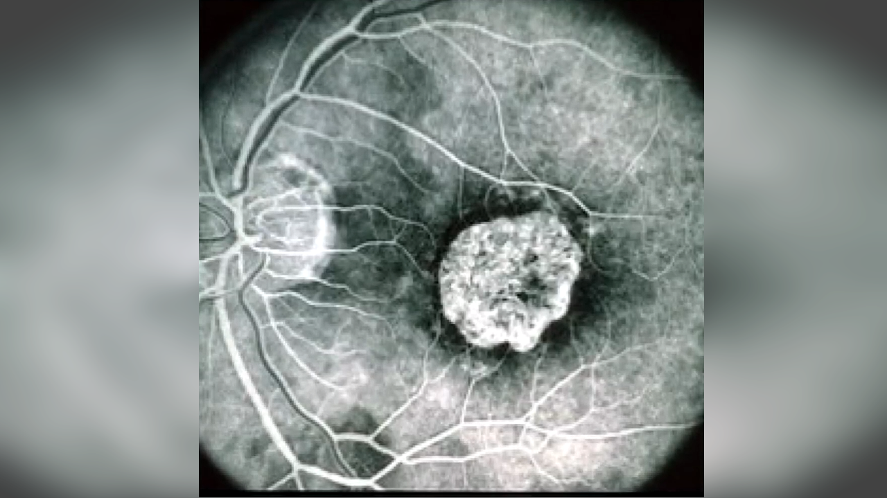 Colírio genético recupera visão de jovem cubano com doença rara