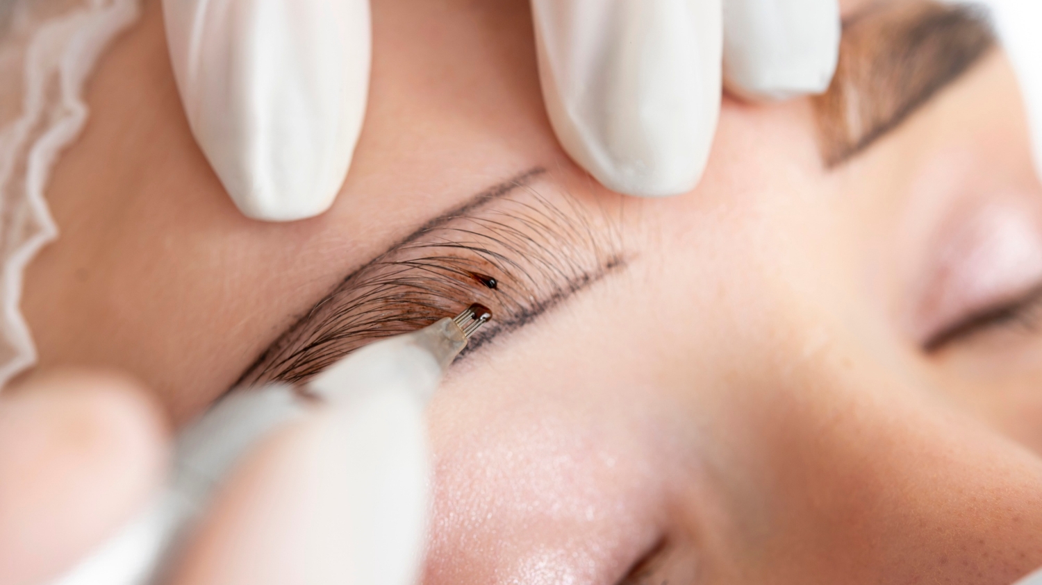 Transplante de sobrancelhas: conheça o procedimento para sobrancelhas falhadas
