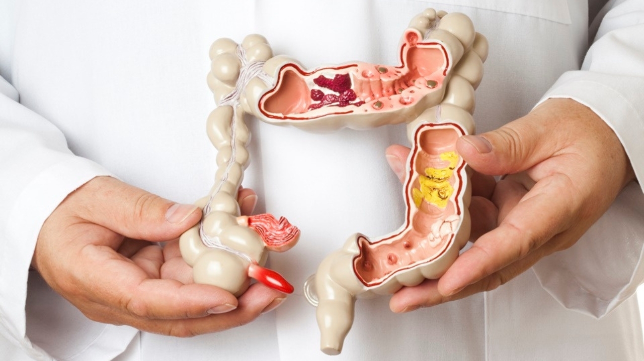 Câncer colorretal tem mortalidade em ascensão na América Latina