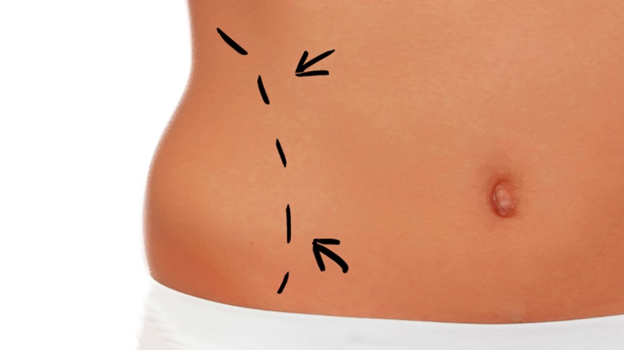 História da lipo mostra como o procedimento evoluiu