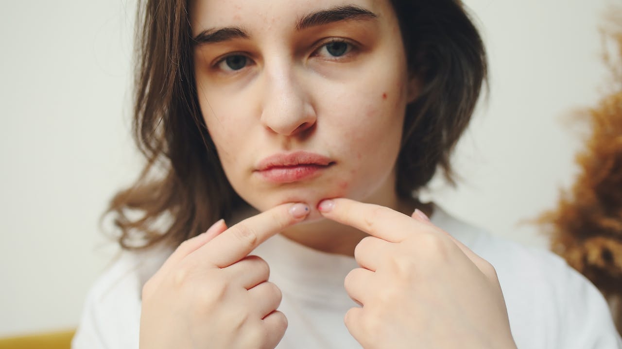 Acne da Mulher Adulta tem se tornado mais frequente nos últimos anos