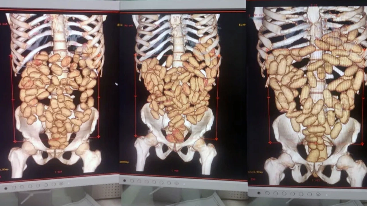 Veja os perigos de armazenar drogas no organismo