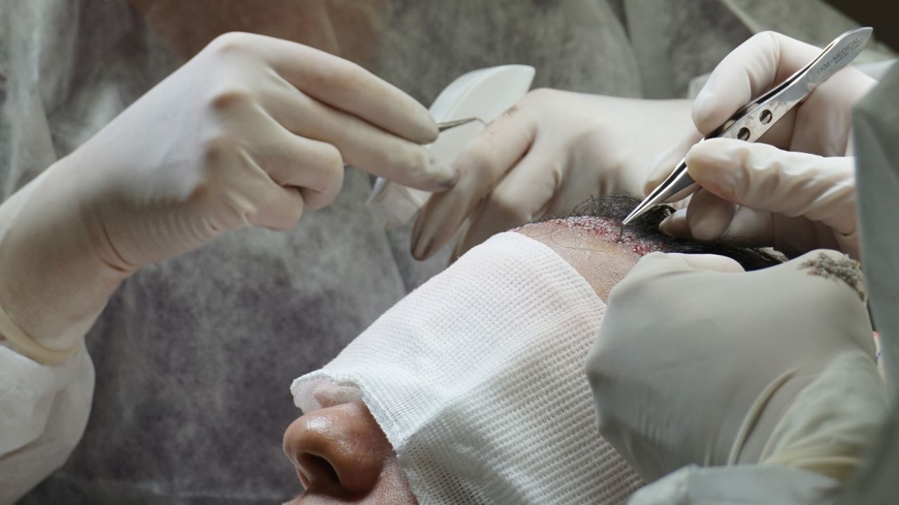 Turquia Hair traz acessibilidade e resultados naturais em transplante capilar