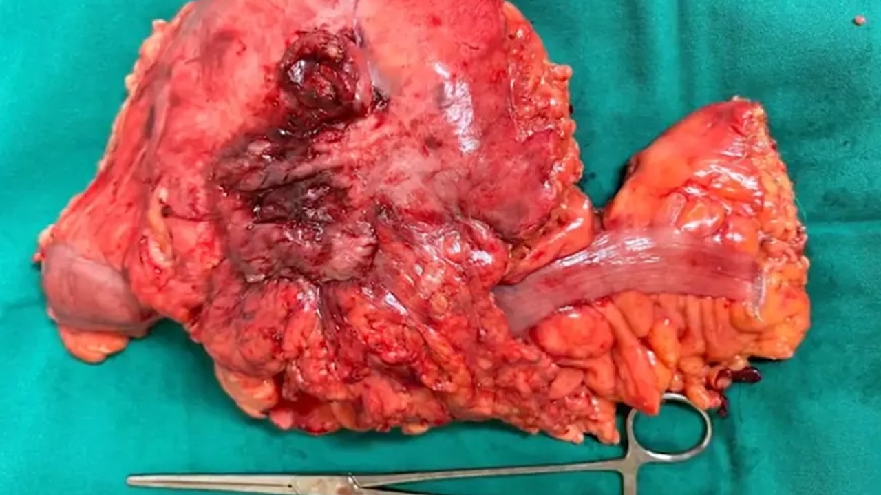 Saiba o que é a rara doença do divertículo gigante do cólon descoberta em hospital do Rio