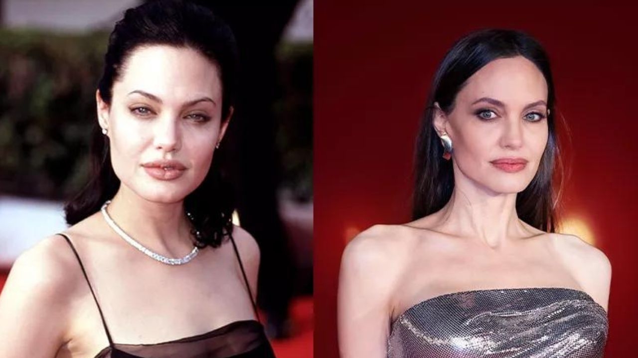 Avanços no lifting facial permitem maior naturalidade após procedimento