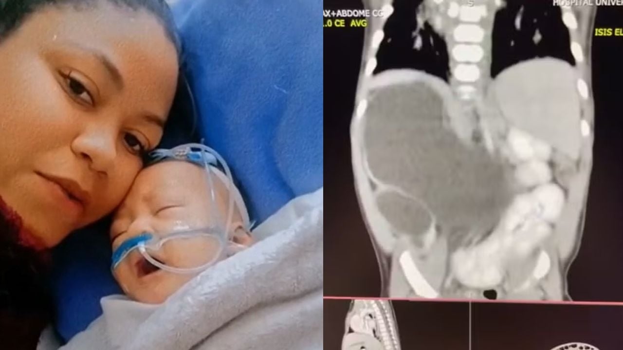 Condição super rara: conheça a bebê que nasceu com quatro rins