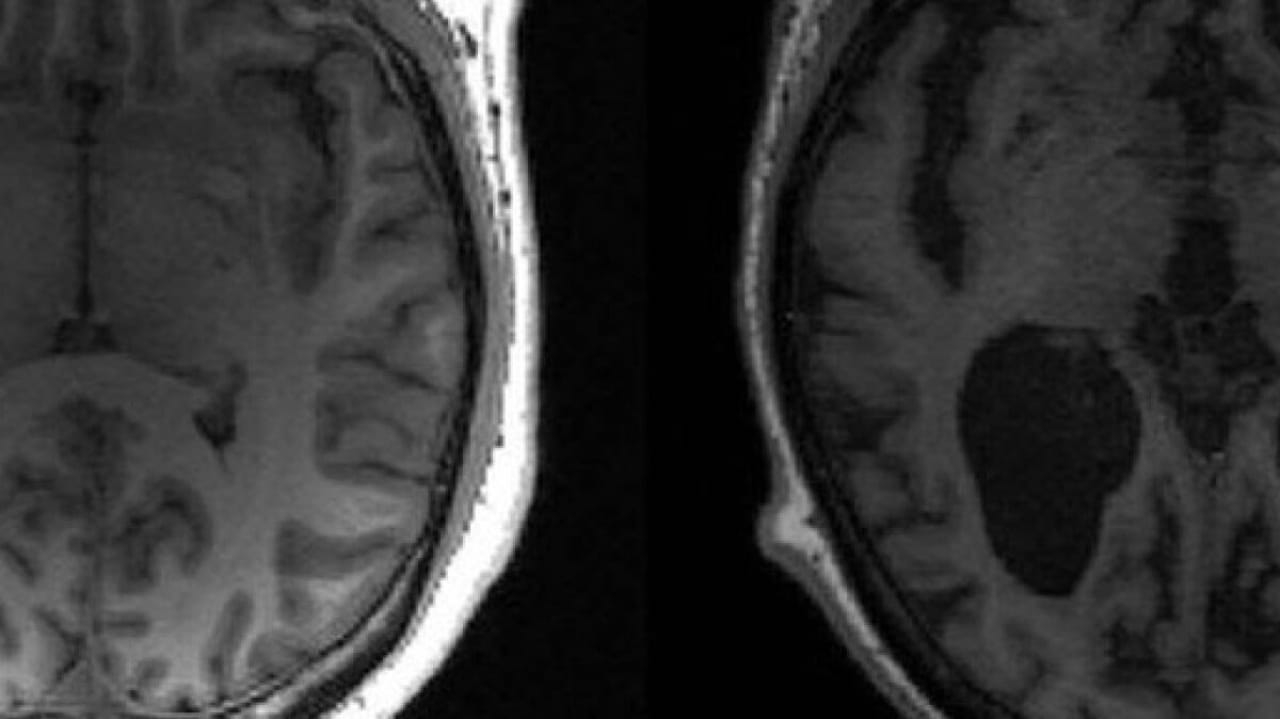 Estudo revela fatores ligados à morte neuronal no Alzheimer