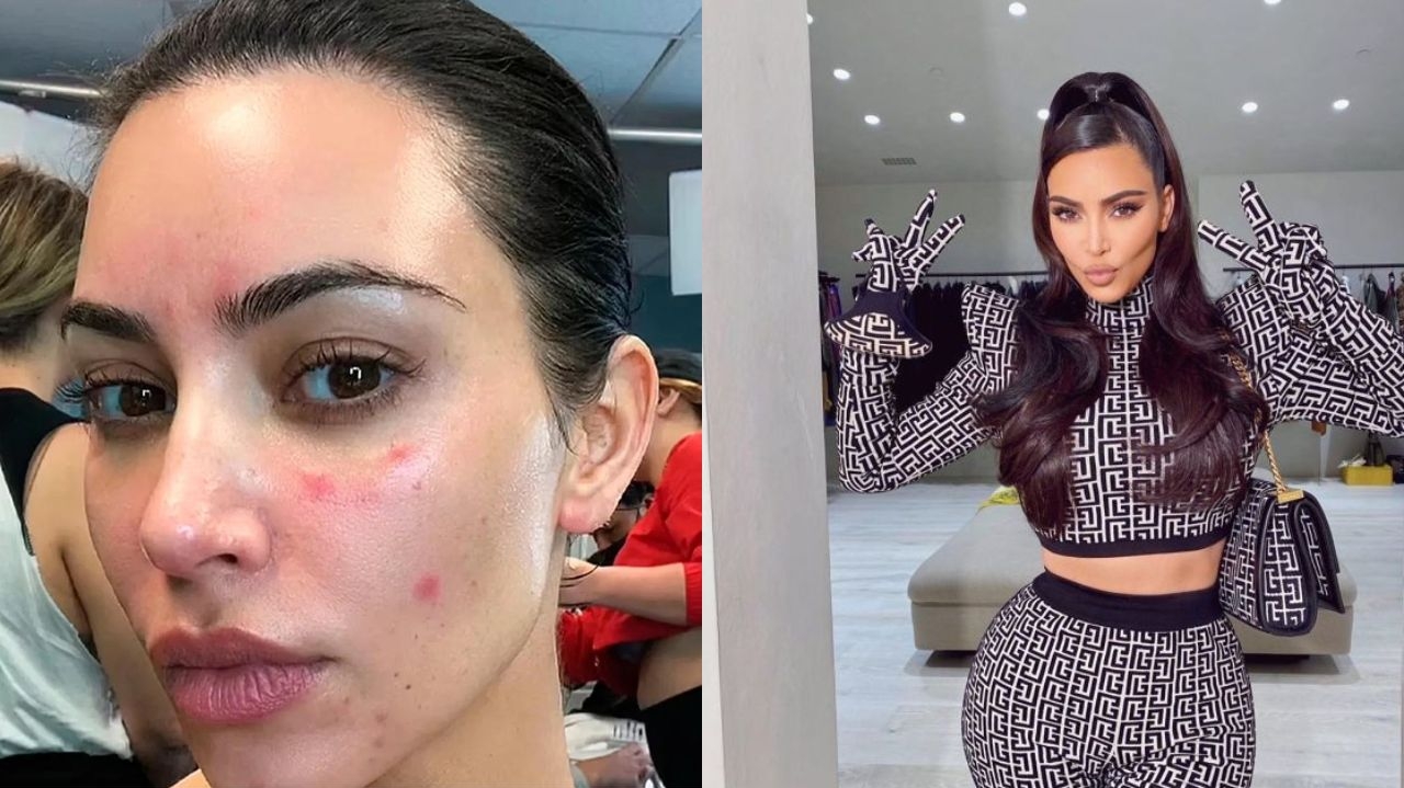 Kim Kardashian lamenta piora em seu quadro de psoríase