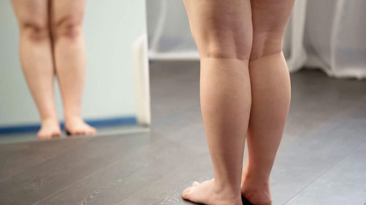 Lipedema pode restringir movimento do joelho e desgastar a articulação