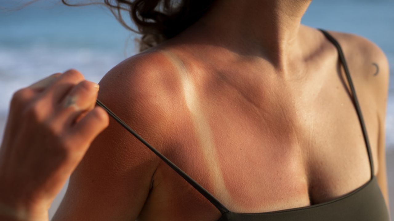 Veja como tratar as queimaduras decorrentes da exposição ao Sol