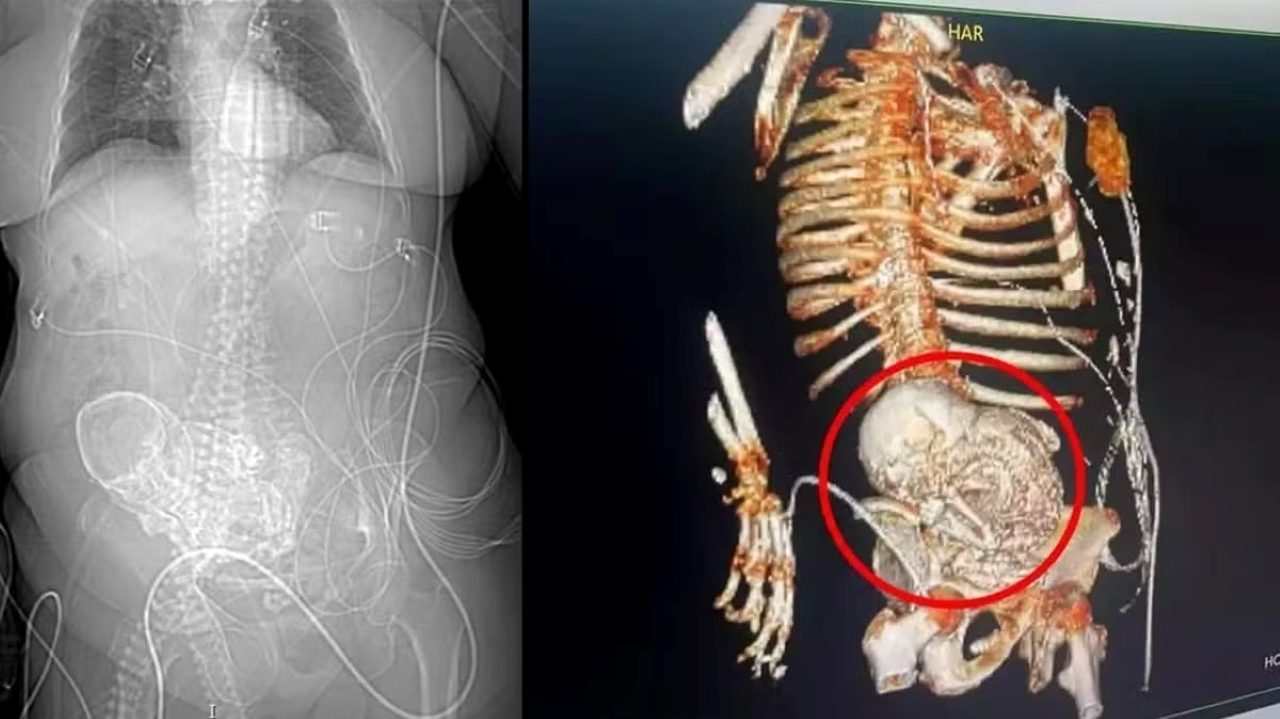 Idosa é identificada com feto calcificado por mais de cinco décadas