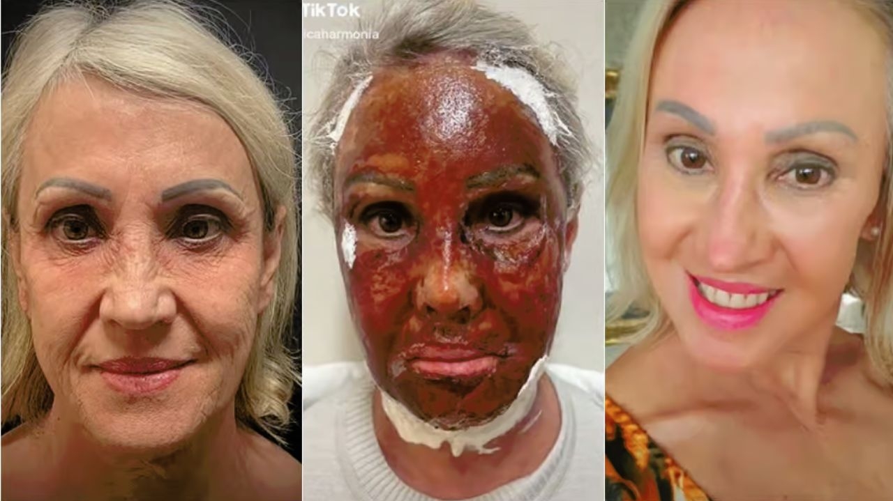 Cicatrizes, manchas e parada cardíaca; conheça os efeitos do peeling de fenol