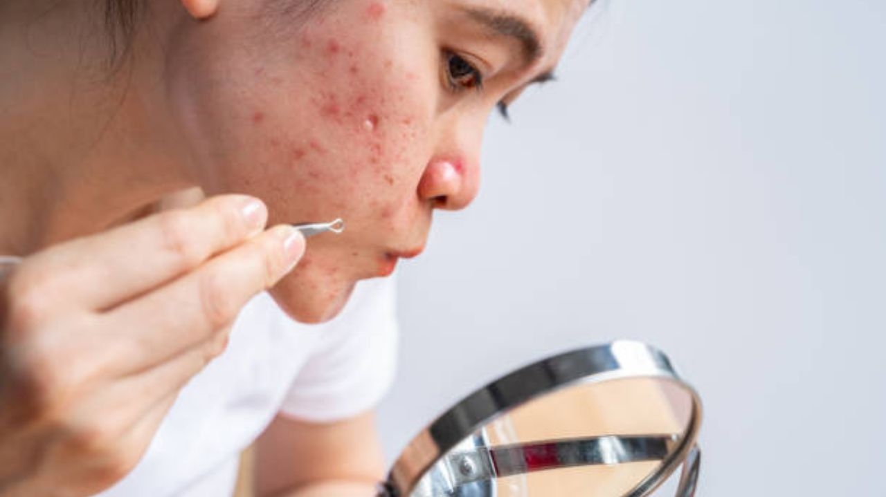 Descubra o que causa acne e saiba como prevenir e tratar