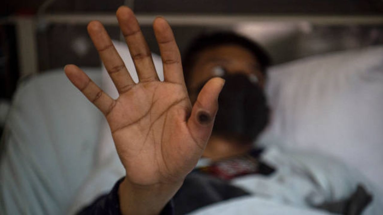 Saiba os sintomas e formas de transmissão da “Mpox”