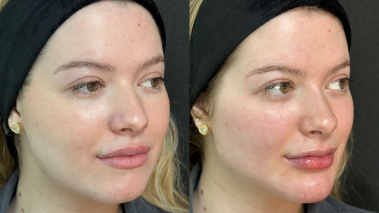 A Fazenda: conheça o especialista queridinho dos famosos para procedimentos estéticos faciais antes e depois do reality