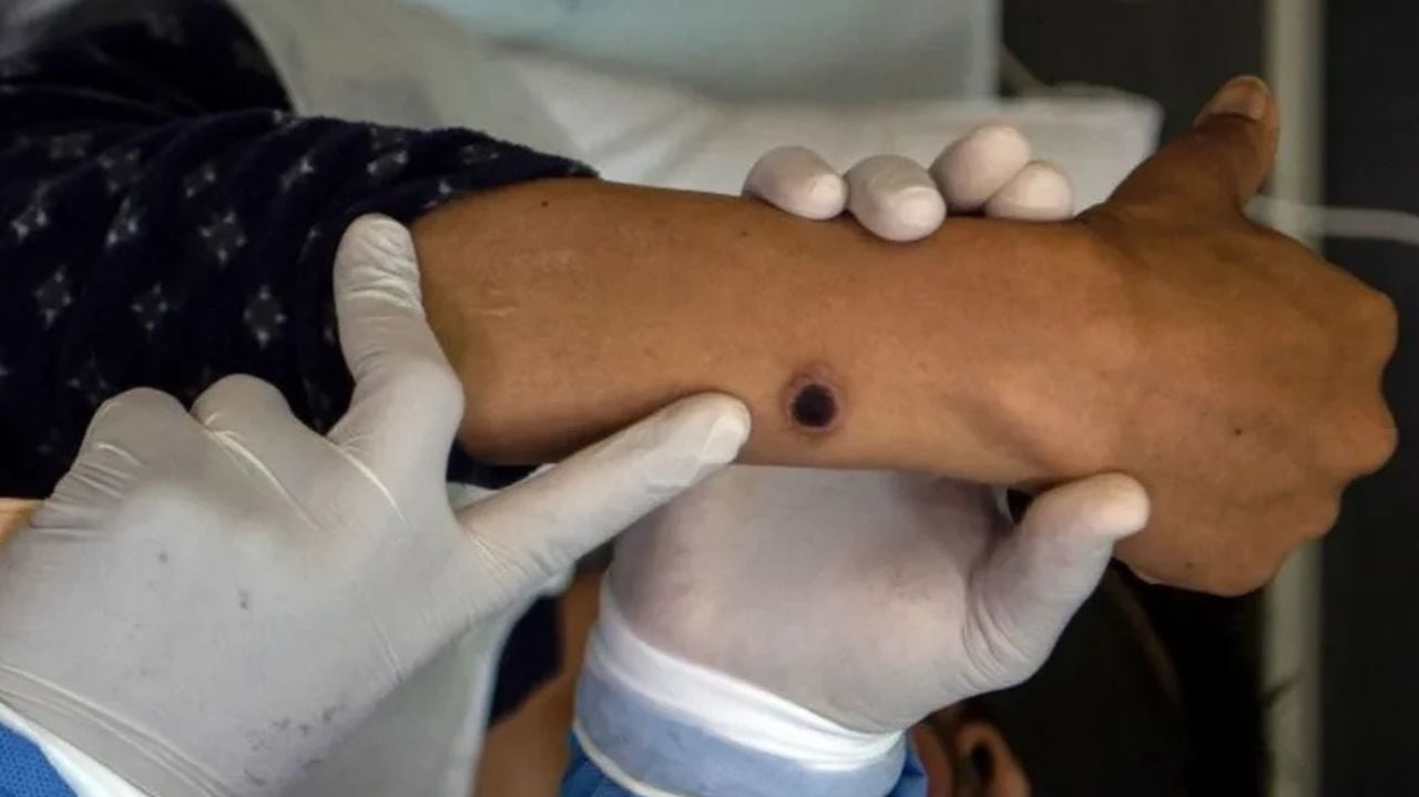 São Paulo confirma primeiro caso da nova variante da Mpox