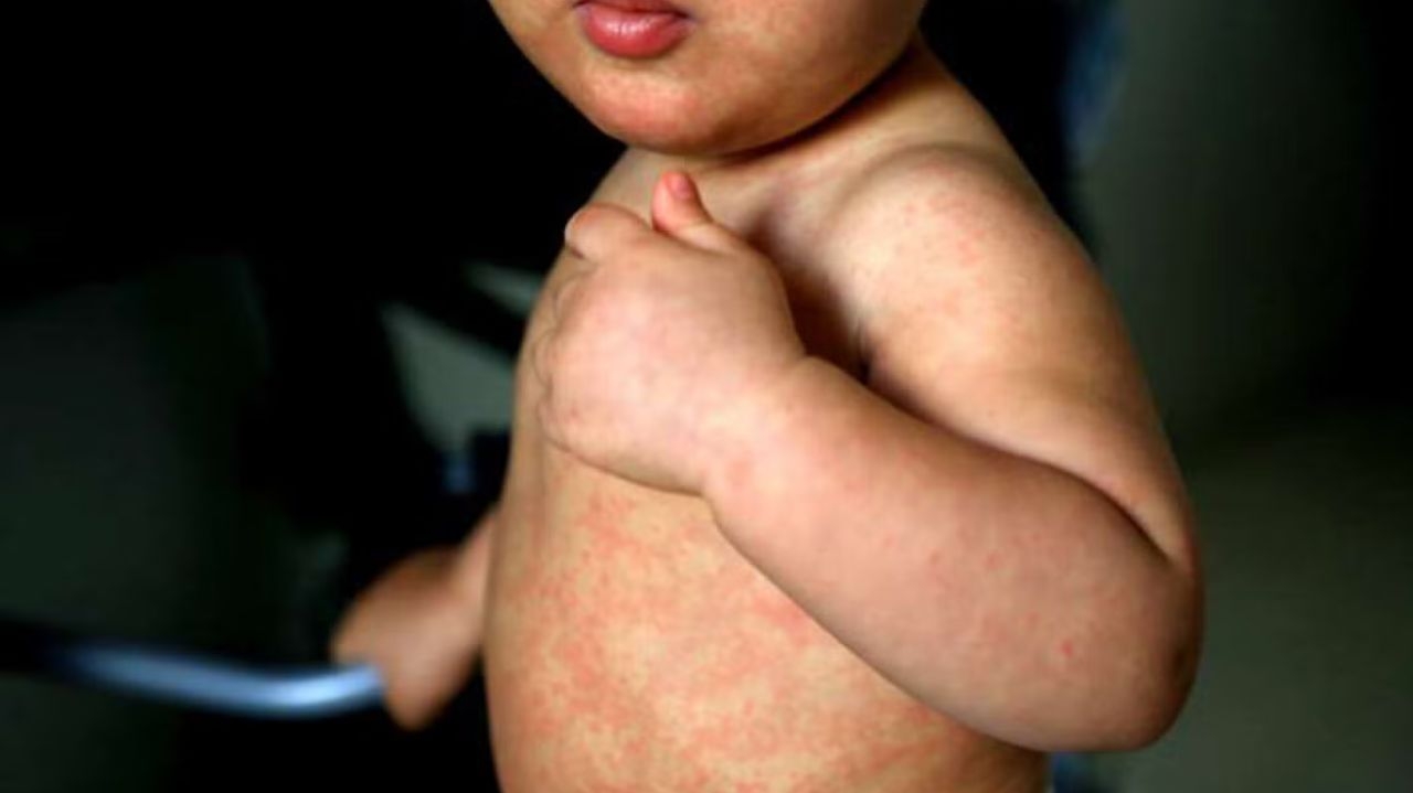 Número de casos de sarampo ultrapassa o total de todo o ano passado