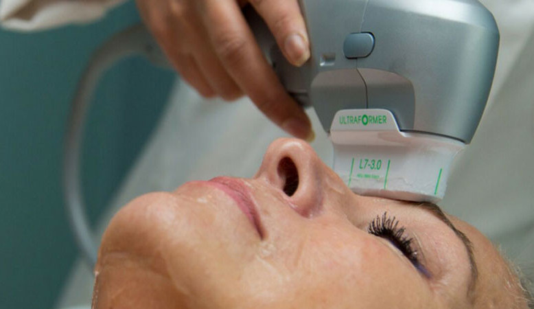 ULTRAFORMER III – Efetividade e praticidade em tratamento contra a flacidez