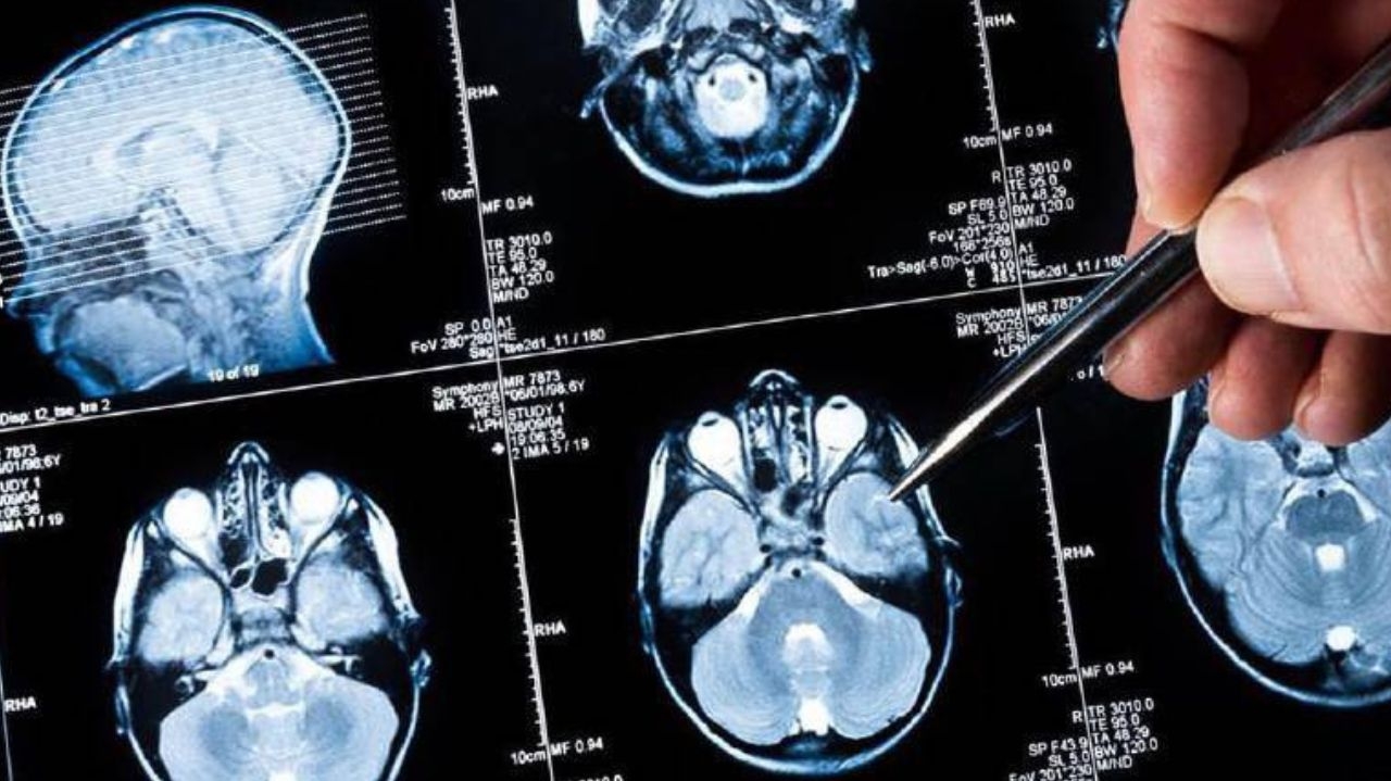 Médicos alertam sobre o risco do câncer cerebral que matou a atriz mirim Millena Brandão