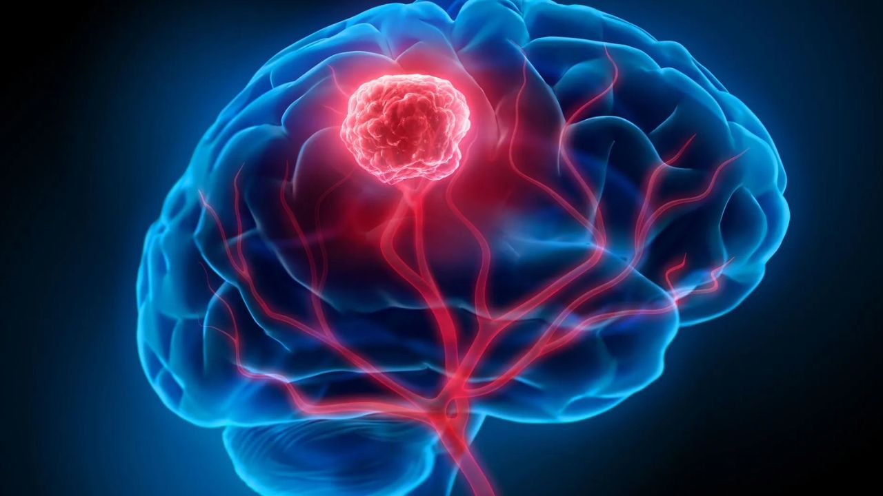 Representação de um tumor no cérebro | Reprodução/Dr. Matheus Yamaki