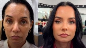 Mônica Carvalho aposta em harmonização facial e transformação chama atenção
