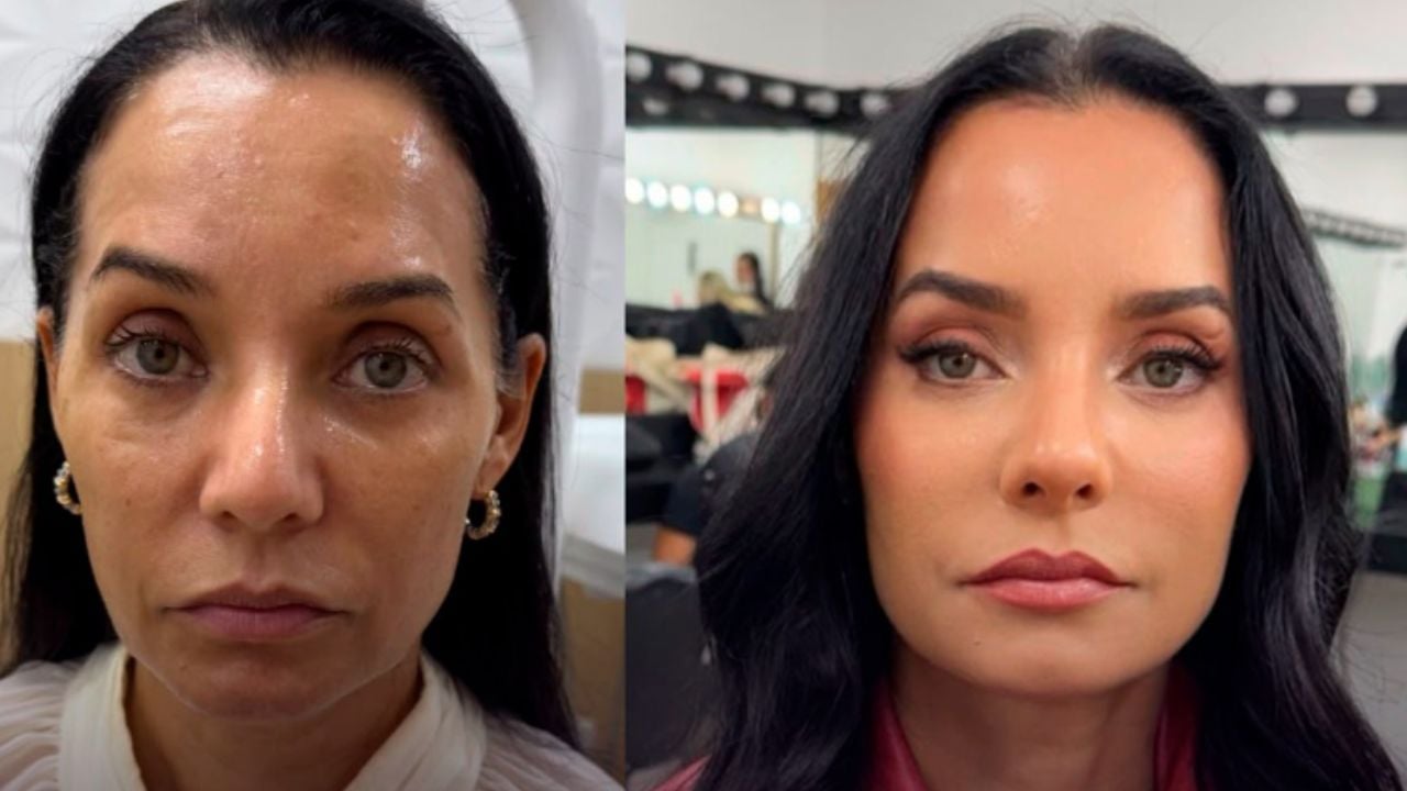 Mônica Carvalho aposta em harmonização facial e transformação chama atenção
