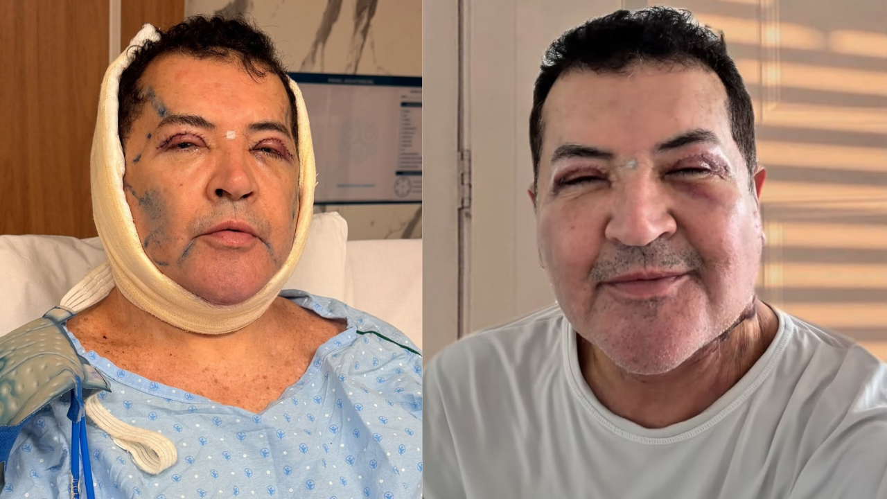 Beto Barbosa mostra recuperação após cirurgia plástica no rosto e revela novo visual